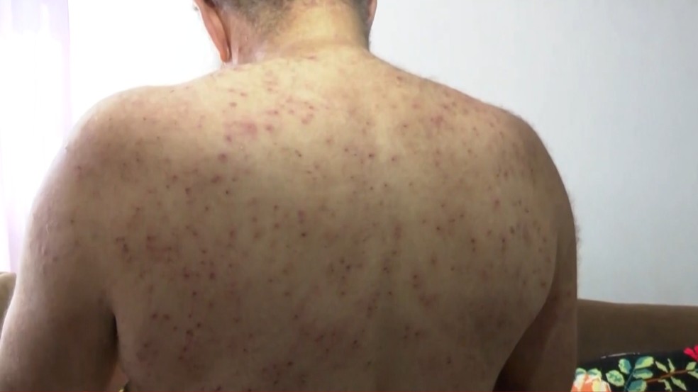 Recuperação de Pedro Gondim após ataque de abelhas é vista como milagre por especialistas